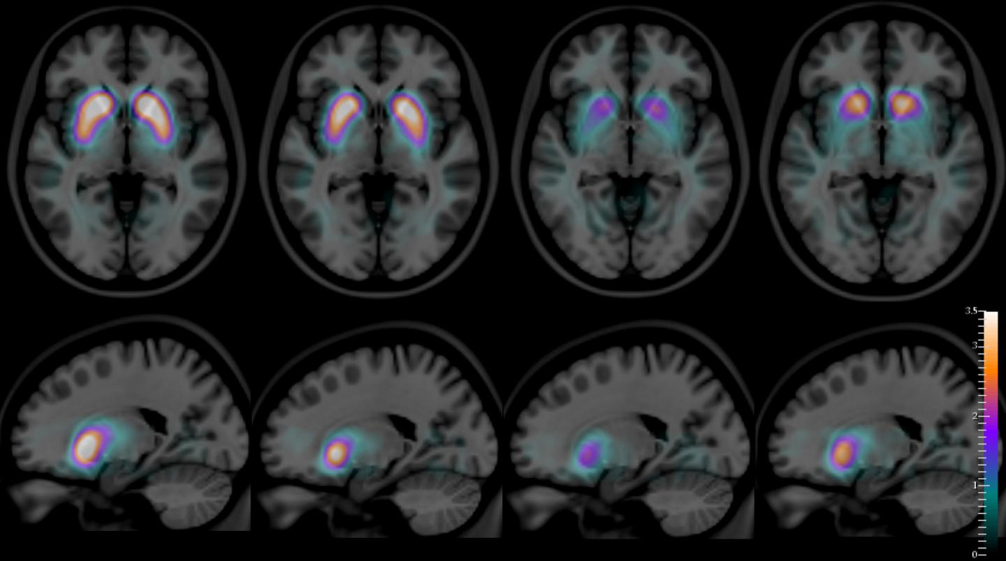 SPECT images for healthy controls, AD, DLB and PD