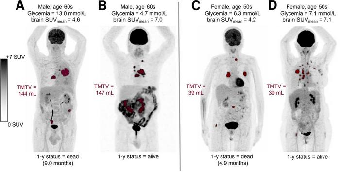 Examples of baseline 18F-FDG PET images of four patients with metastatic NSCLC.