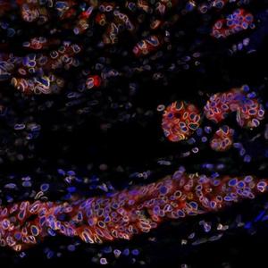 Relapses of breast cancer: discovery of a key cellular resistance mechanism