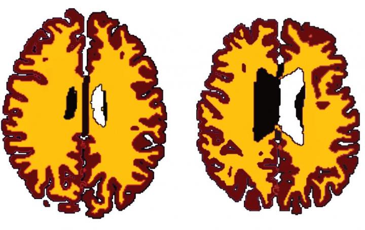 Brains of Lean and Overweight Individuals