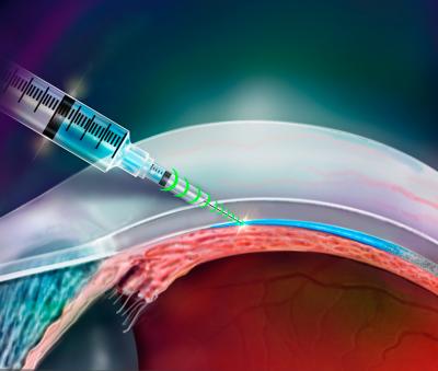 Researchers Invent a Needle that Knows Where to Go
