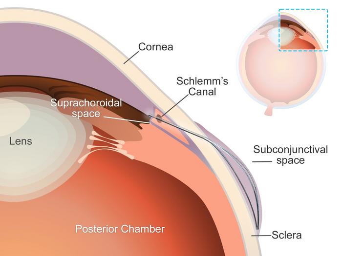 Schematic, microstent for glaucoma