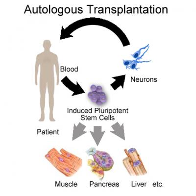 Autotransplantation