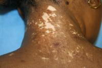 Neck After Surgery