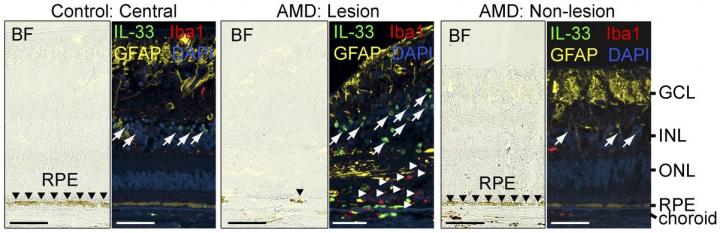 Increased Expression of Il-33 in Areas of Macular Degeneration