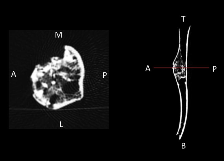 Right Humerus CT Scan