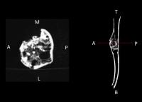 Right Humerus CT Scan