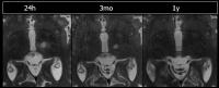 Minimally Invasive Procedure Relieves Tremors in Parkinson's Patients