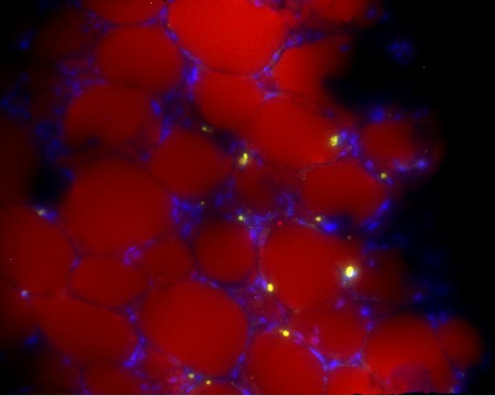 Leukemia Cells