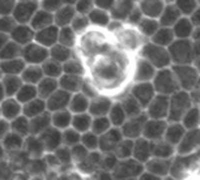 Transformed Cells Becoming Extruded