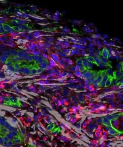 Pancreatic tumor microscopy