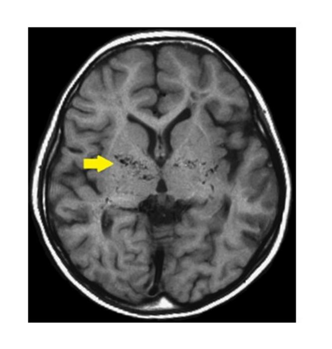 Moyamoya disease-MRI T1
