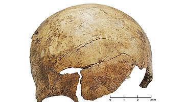 Cranial Injury