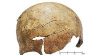 Cranial Injury