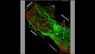 Neural Tube Defects Remain Significant Health Burden 