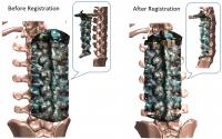 Images of Spine before Registration and After Registration Using iSV