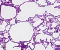 Aggressive Breast Tumor, Post-Treatment with ASO