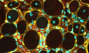 LAMA2-related muscular dystrophy