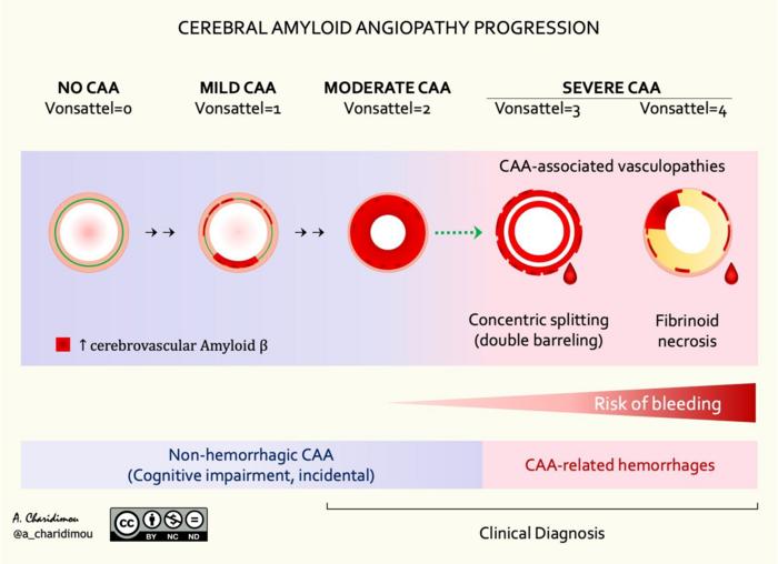 Cerebral amyloid angiopathy progression