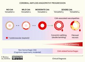 Cerebral amyloid angiopathy progression