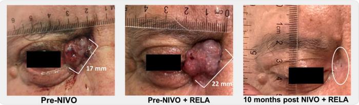locally-advanced BCC after resistance to 26 wks of nivolimab alone