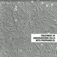 Treatment of Angiosarcoma with Propranolol