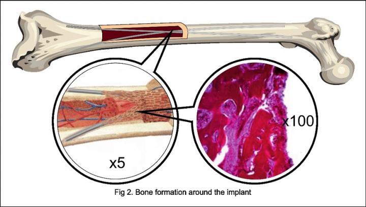 Implants Doubling Limb Lengthening
