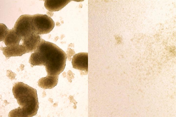Zika Killing Glioblastoma Stem Cells
