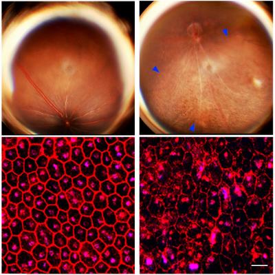 Retinal Photographs