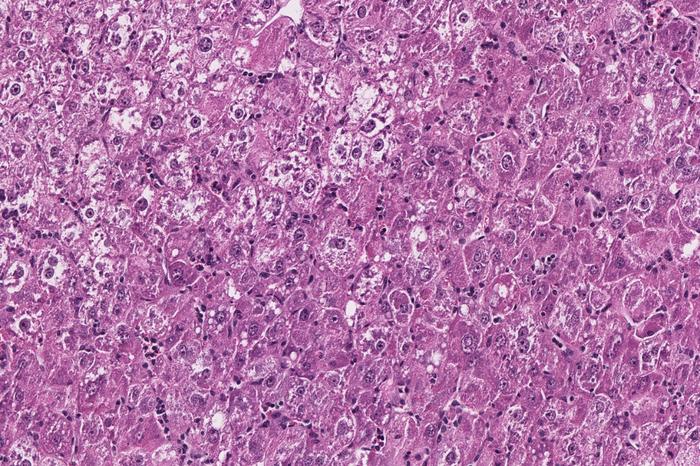 Liver tumor