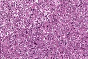 Liver tumor