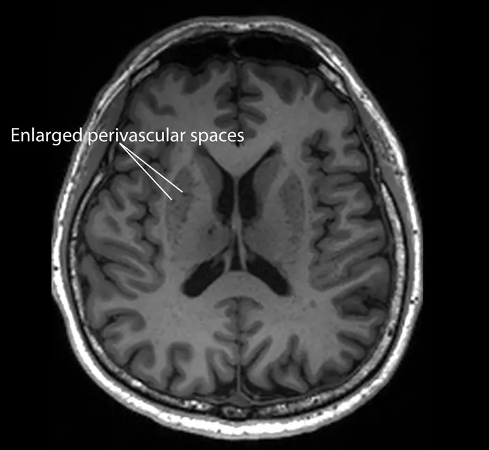 Image 3 - MRI image of a patient with enlarged perivascular spaces