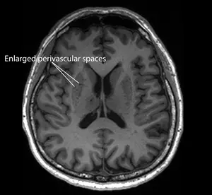 Image 3 - MRI image of a patient with enlarged perivascular spaces