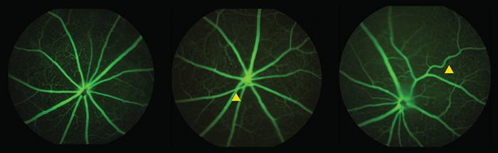 Mthfr 677C>T retinal changes