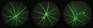 Mthfr 677C>T retinal changes