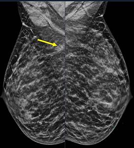 Extremely dense breast tissue is noted on mammography
