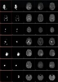 Brain Images from the BRaTS Challenge