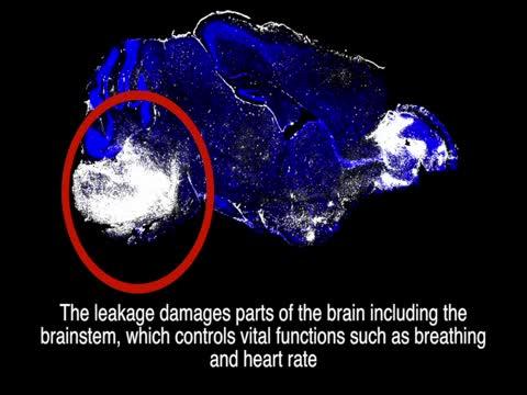 Cerebral Malaria Video