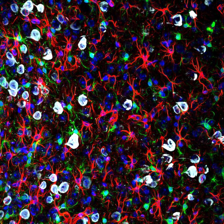 A Safe and Established Drug Could Help Treat Neurodegenerative Disorders (3 of 5)