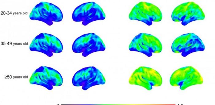 People with Down syndrome have early neuroinflammation