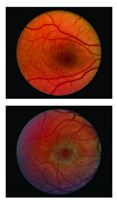 Study confirms long-term benefit of implant for blinding eye disease