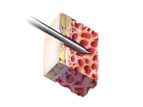 Can Blood Test Replace Bone Marrow Biopsy for Myeloma Patients? (1 of 5)