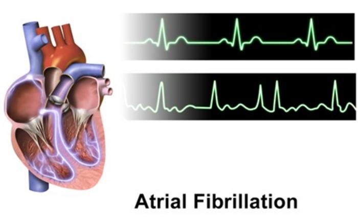 Exploring the gaps in sepsis-associated atrial fibrillation