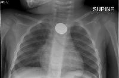 Button Battery X-Rray