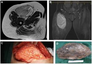 Adult fibrosarcoma: From clinical challenges to cutting-edge innovations