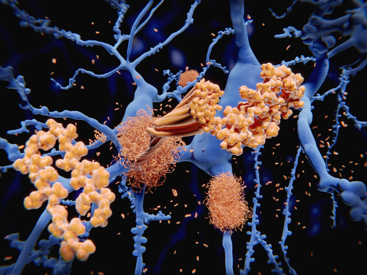 Amyloid-Beta Peptide Plaques