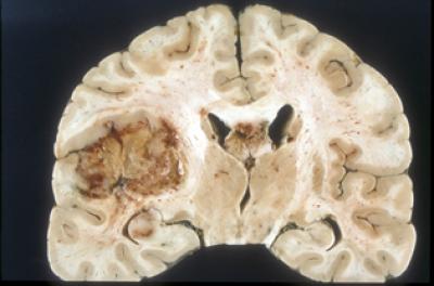Glioblastoma Multiforme