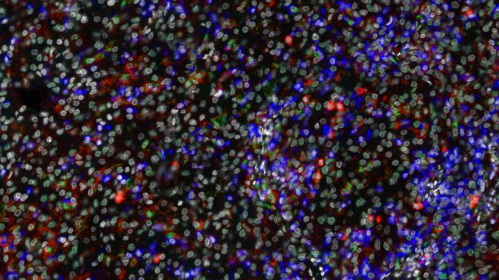 Immune Cells in Renal Cell Carcinoma