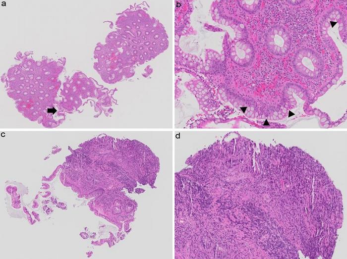 Discrepancy in Nancy index grading of hematoxylin and eosin-stained biopsy images by pathologists