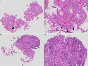 Discrepancy in Nancy index grading of hematoxylin and eosin-stained biopsy images by pathologists